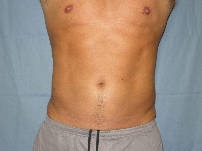 Liposuction - Case 4725 - After