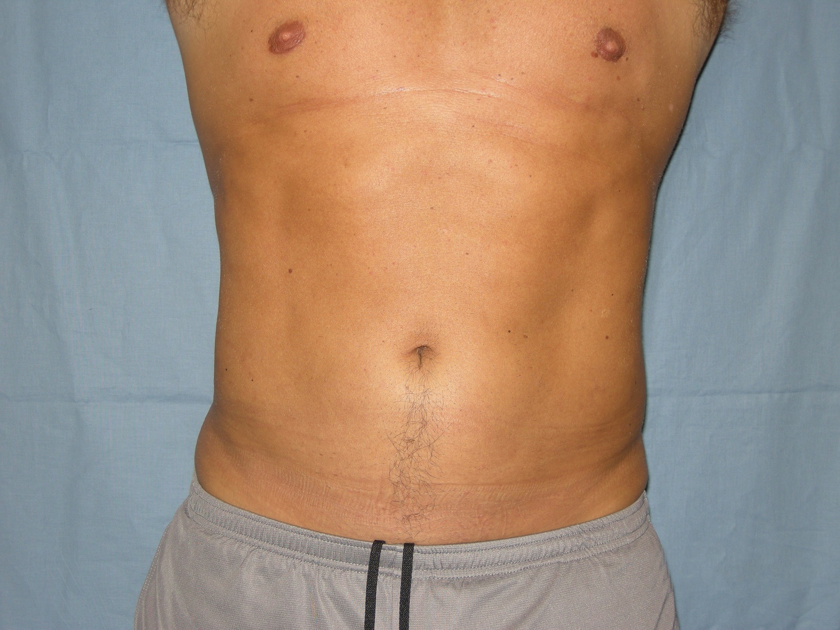 Liposuction Patient Photo - Case 4725 - after view