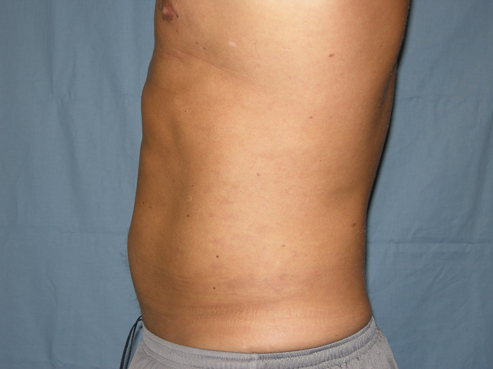 Liposuction Patient Photo - Case 4725 - after view-1
