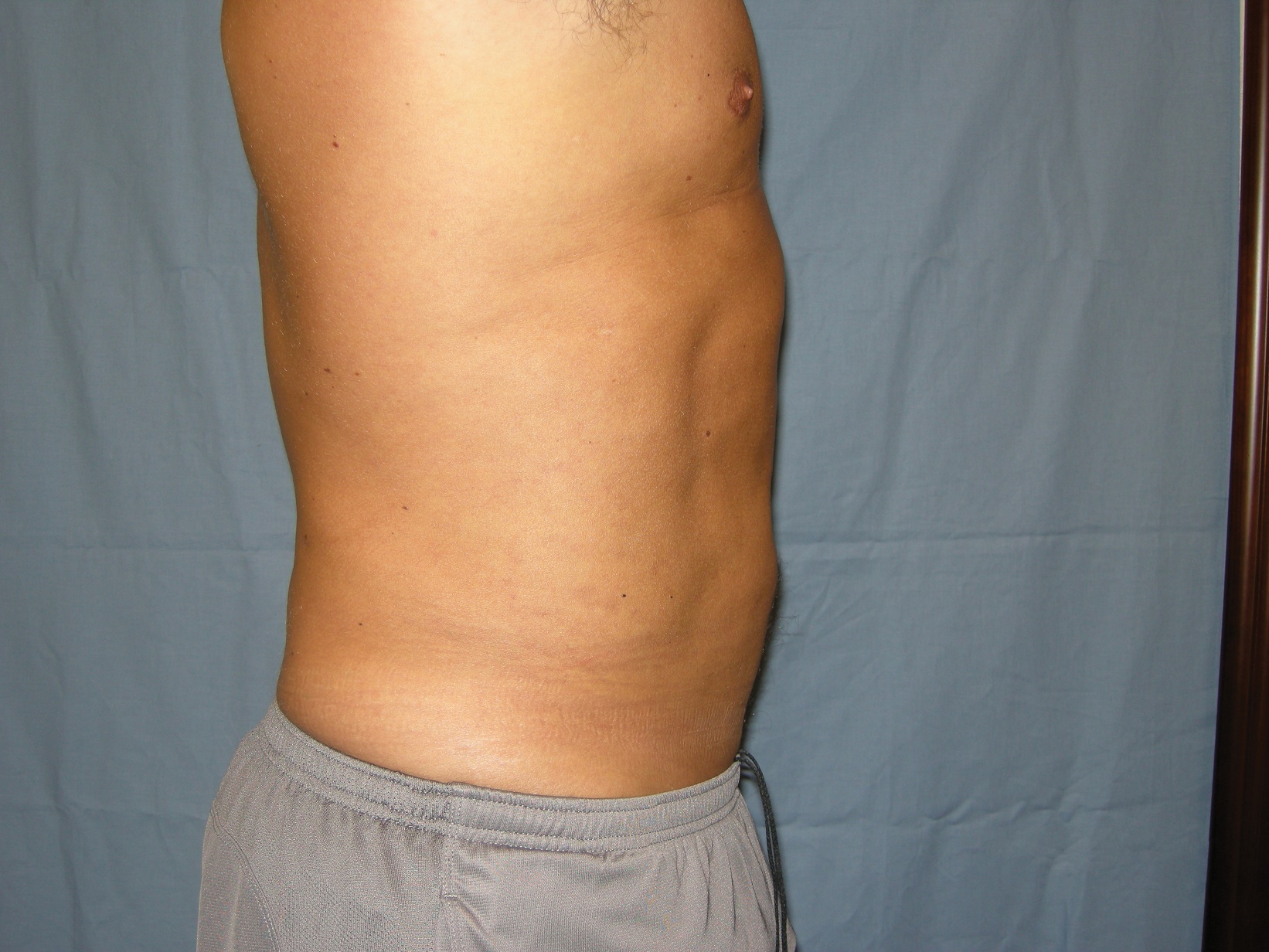 Liposuction Patient Photo - Case 4725 - before view-2