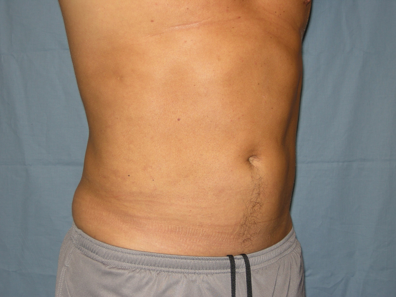 Liposuction Patient Photo - Case 4725 - after view-4