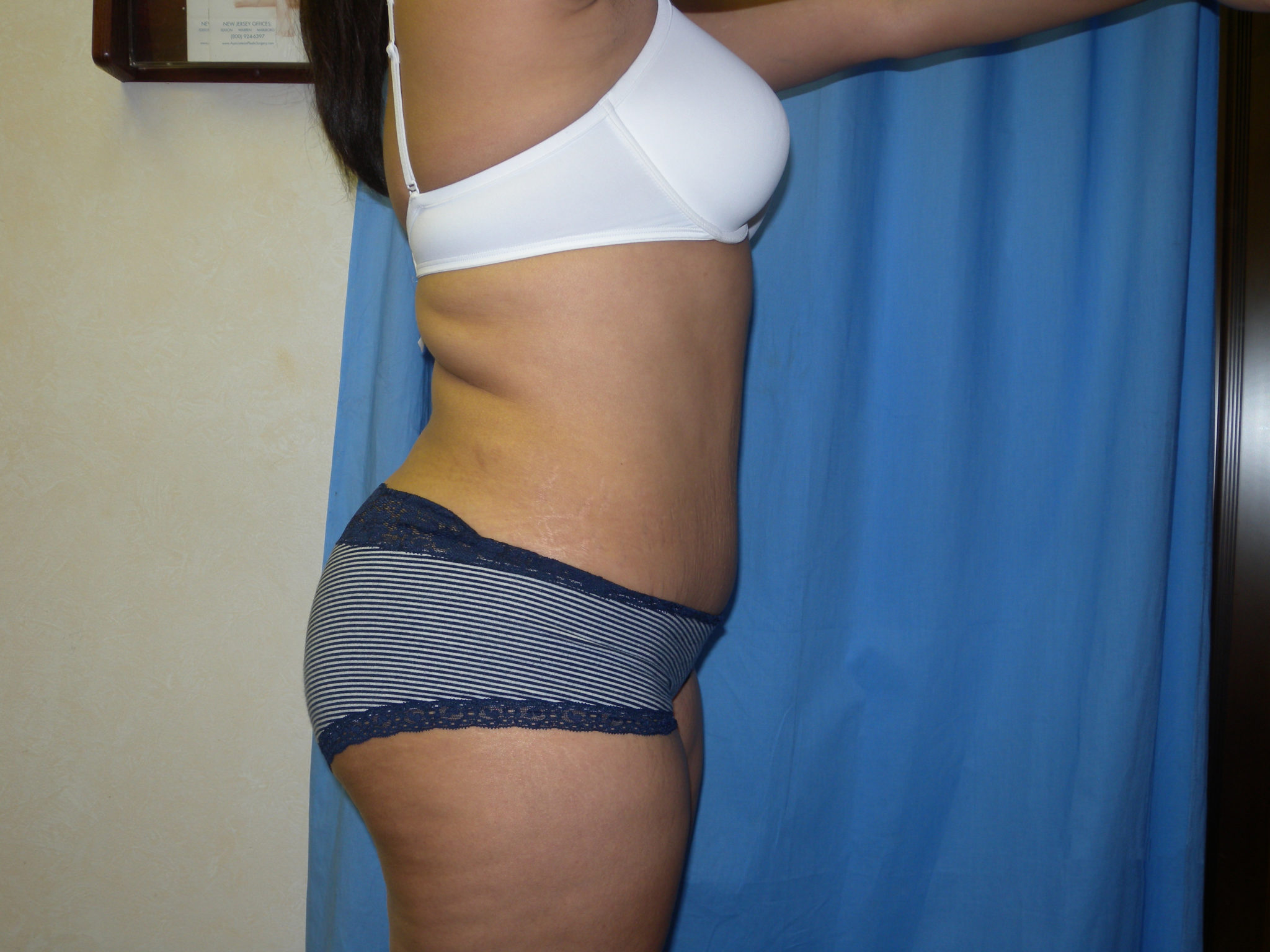 Tummy Tuck Patient Photo - Case 3308 - after view-3