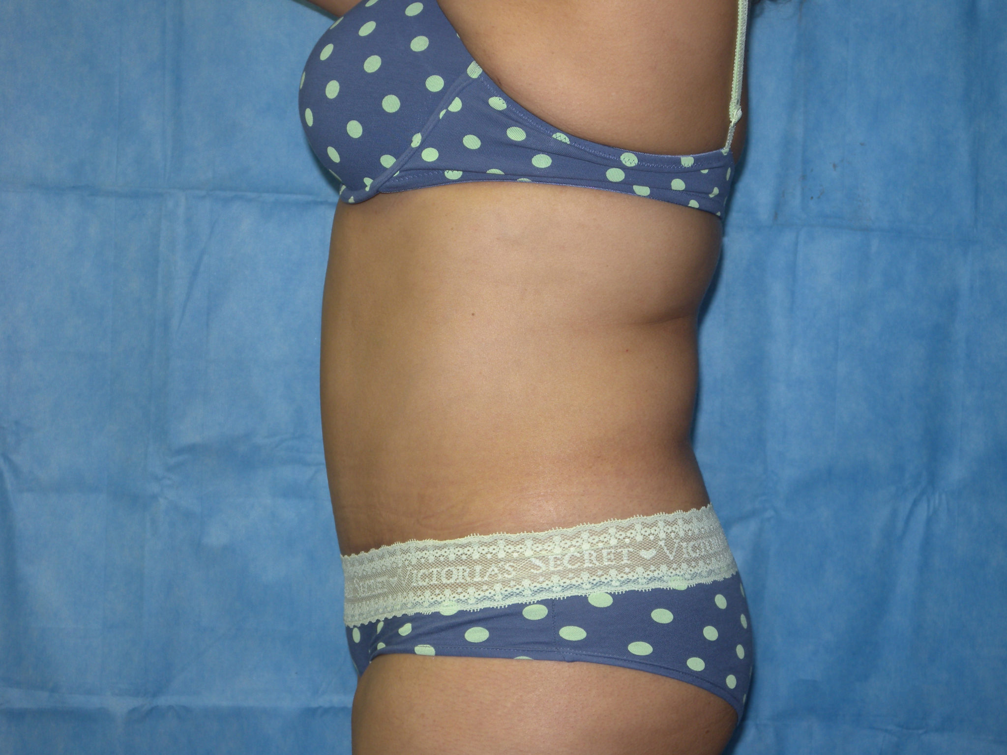 Tummy Tuck Patient Photo - Case 3359 - after view-1