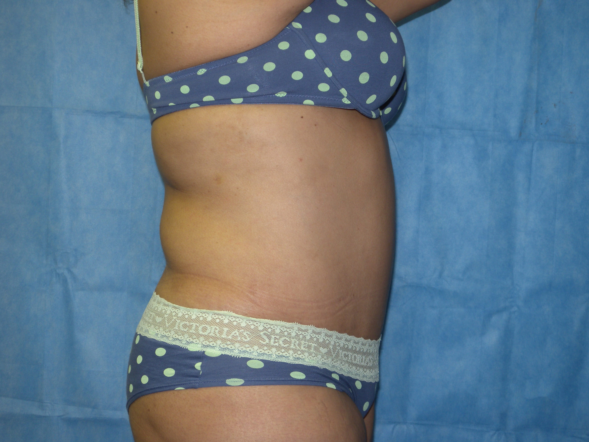 Tummy Tuck Patient Photo - Case 3359 - after view-3