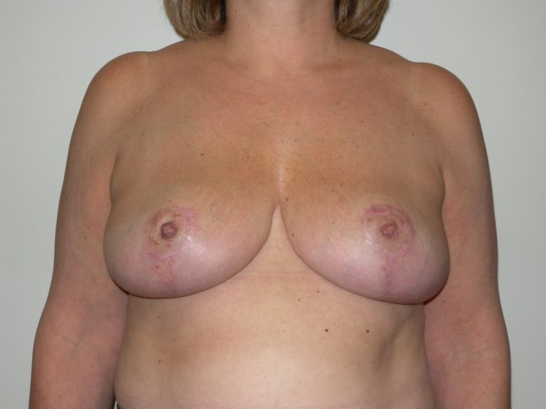 Breast Reduction - Case 4446 - After