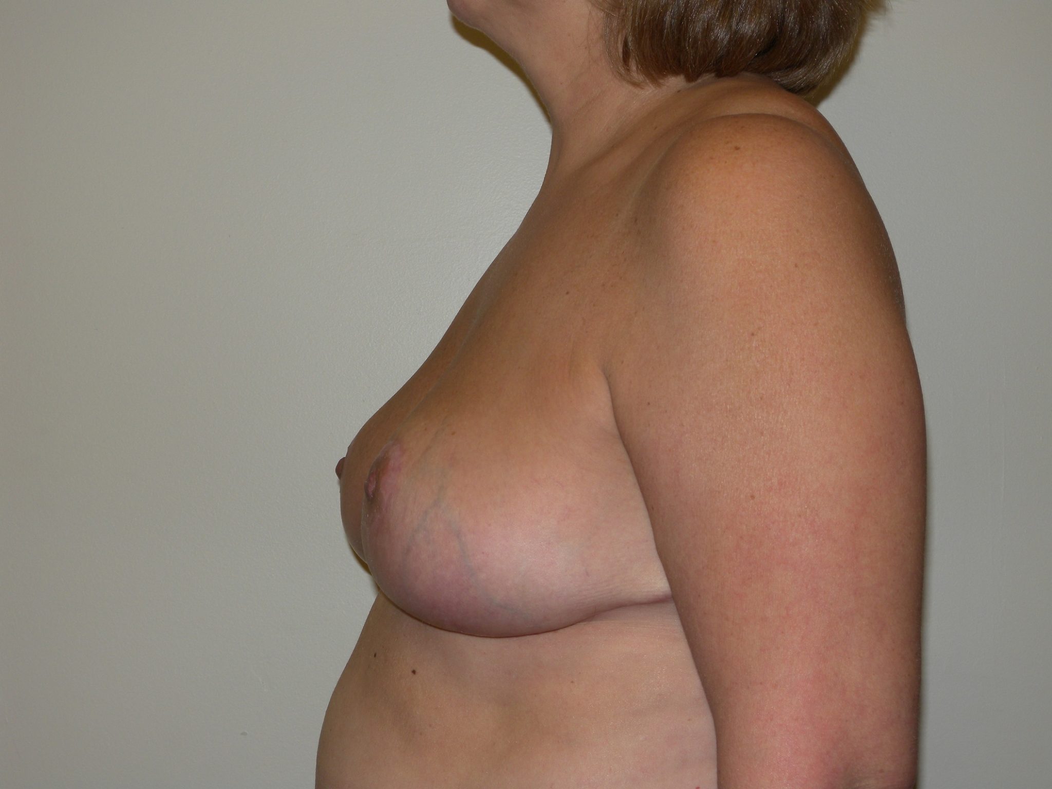 Breast Reduction Patient Photo - Case 4446 - after view-1