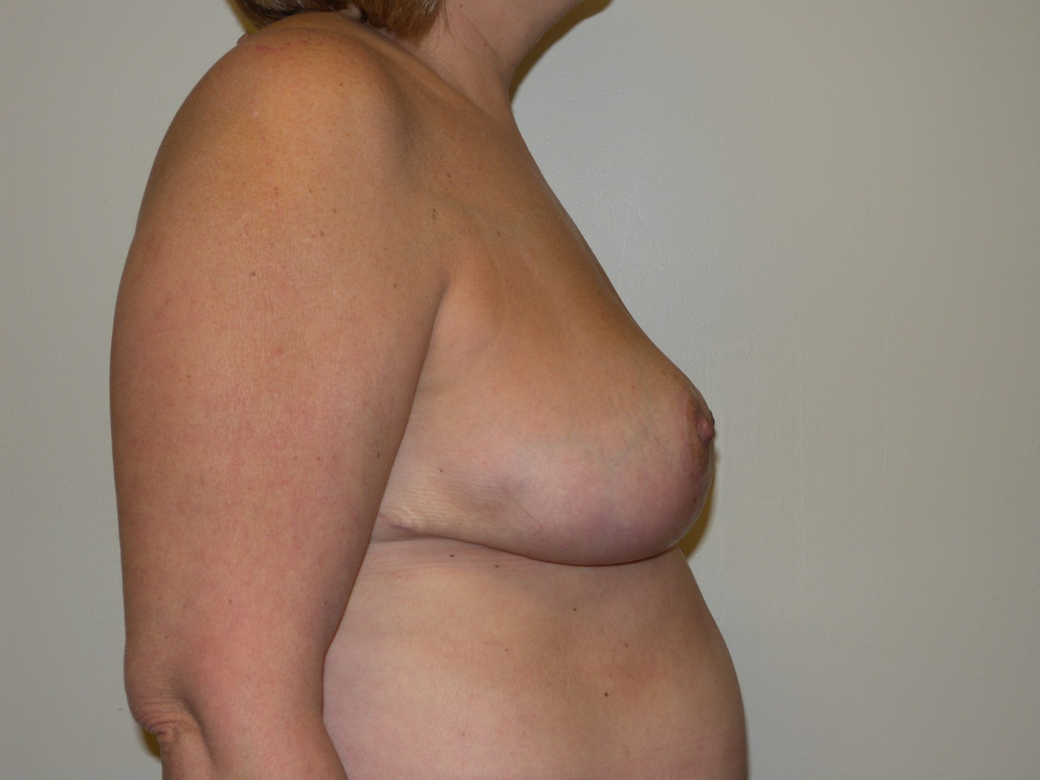 Breast Reduction Patient Photo - Case 4446 - after view-2