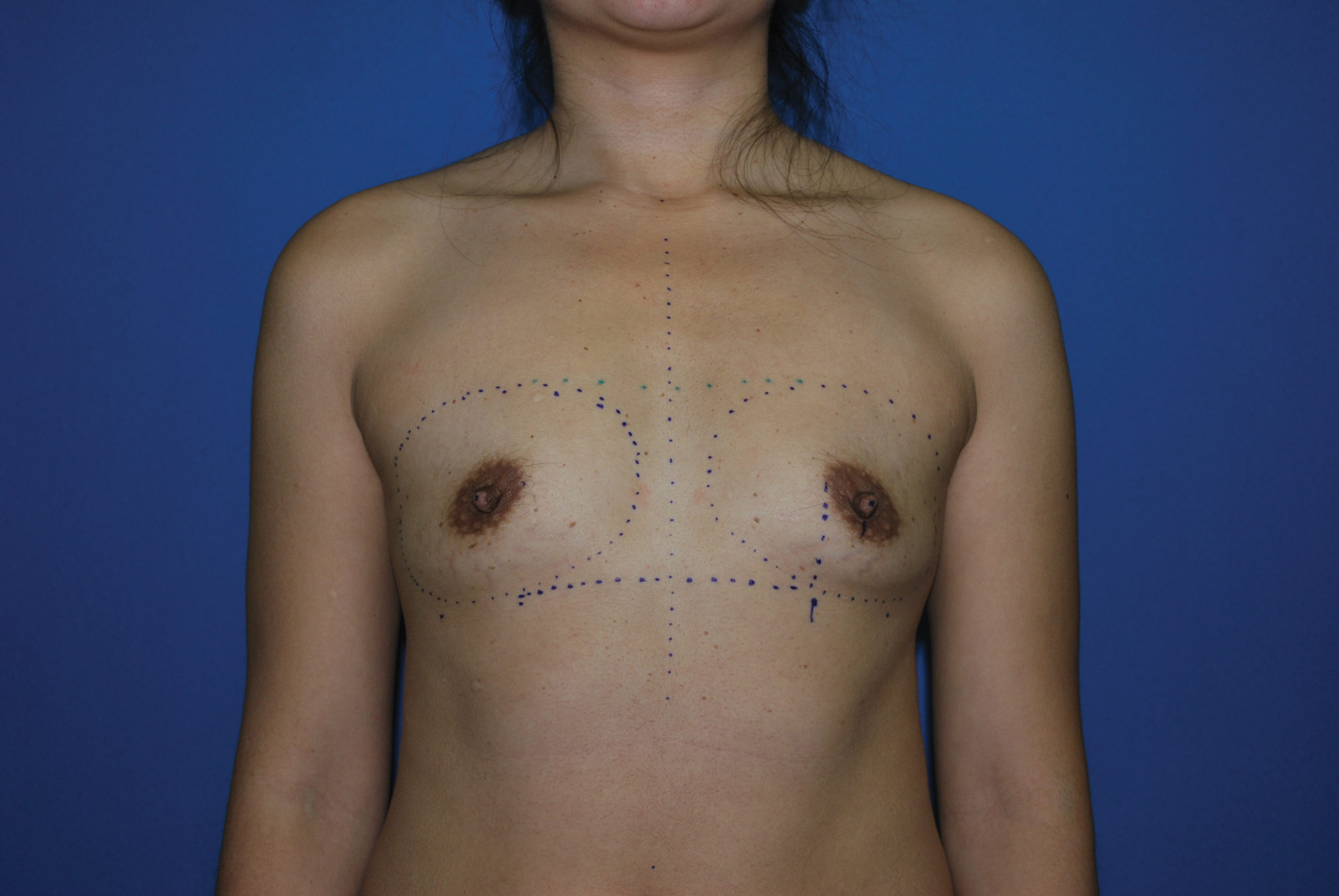 Breast Augmentation Patient Photo - Case 4237 - before view-0