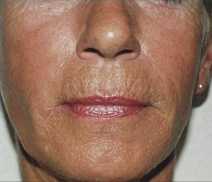 Fillers Patient Photo - Case 5442 - after view