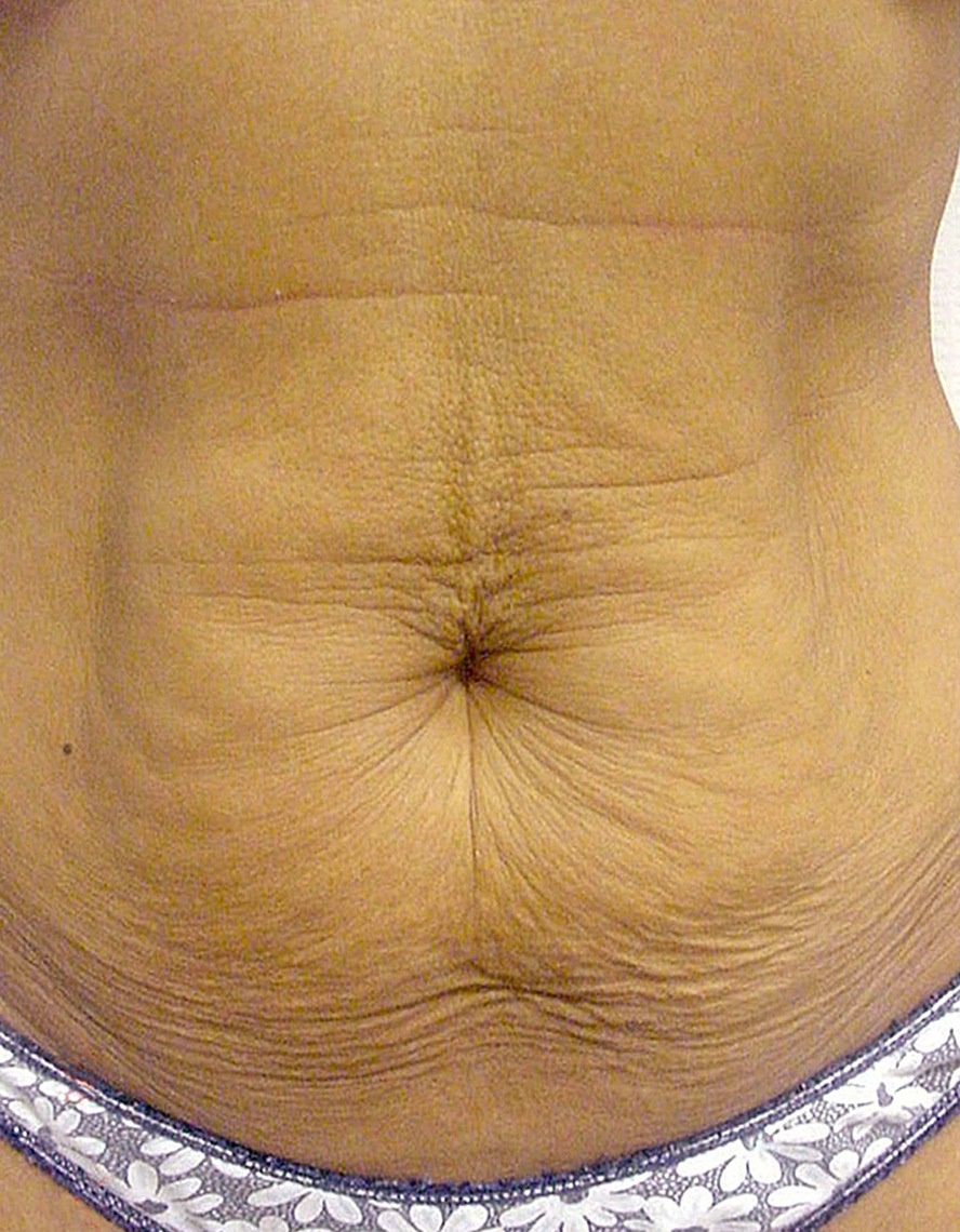 Thermage Patient Photo - Case 5430 - before view-0