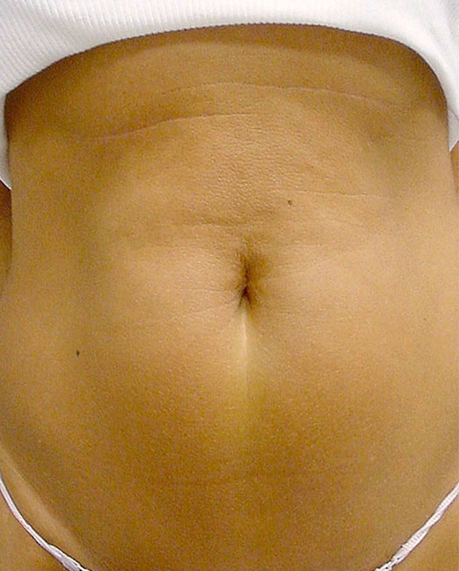 Thermage Patient Photo - Case 5430 - after view