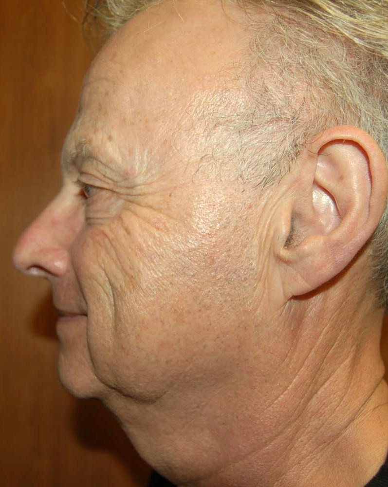 Facial Rejuvenation Patient Photo - Case 5167 - before view-1