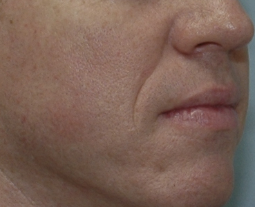 Fillers - Case 5435 - Before