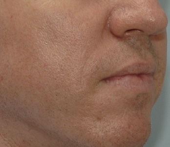 Fillers Patient Photo - Case 5435 - after view-0