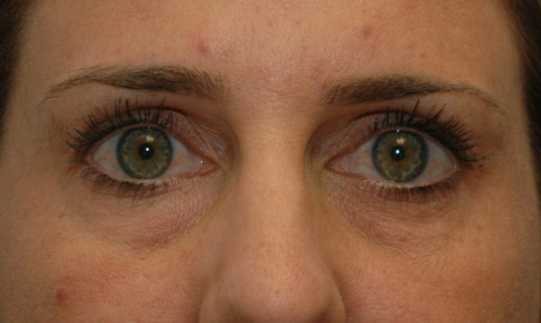Fillers - Case 5443 - Before