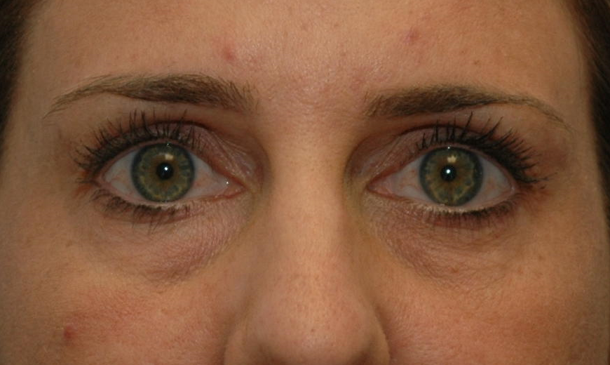 Fillers Patient Photo - Case 5443 - before view-0