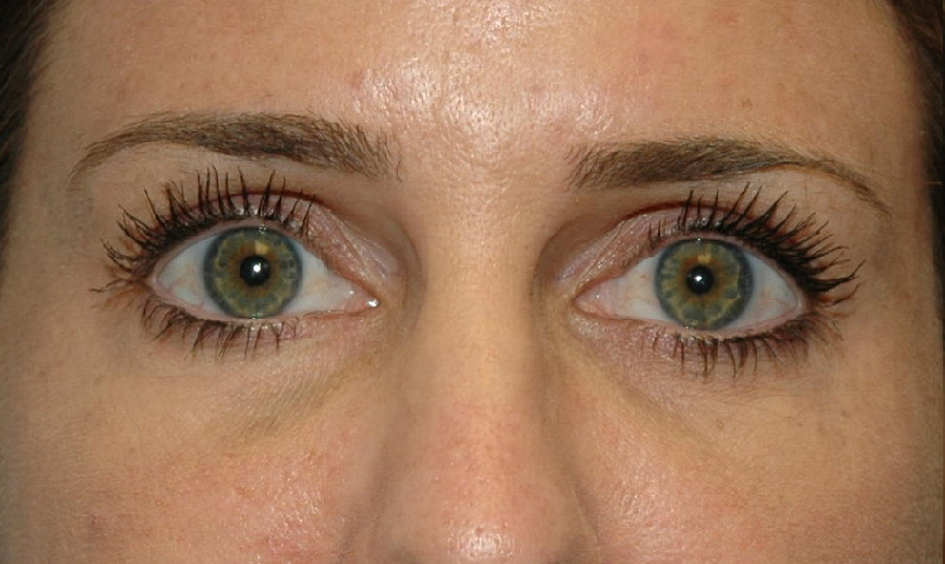 Fillers Patient Photo - Case 5443 - after view