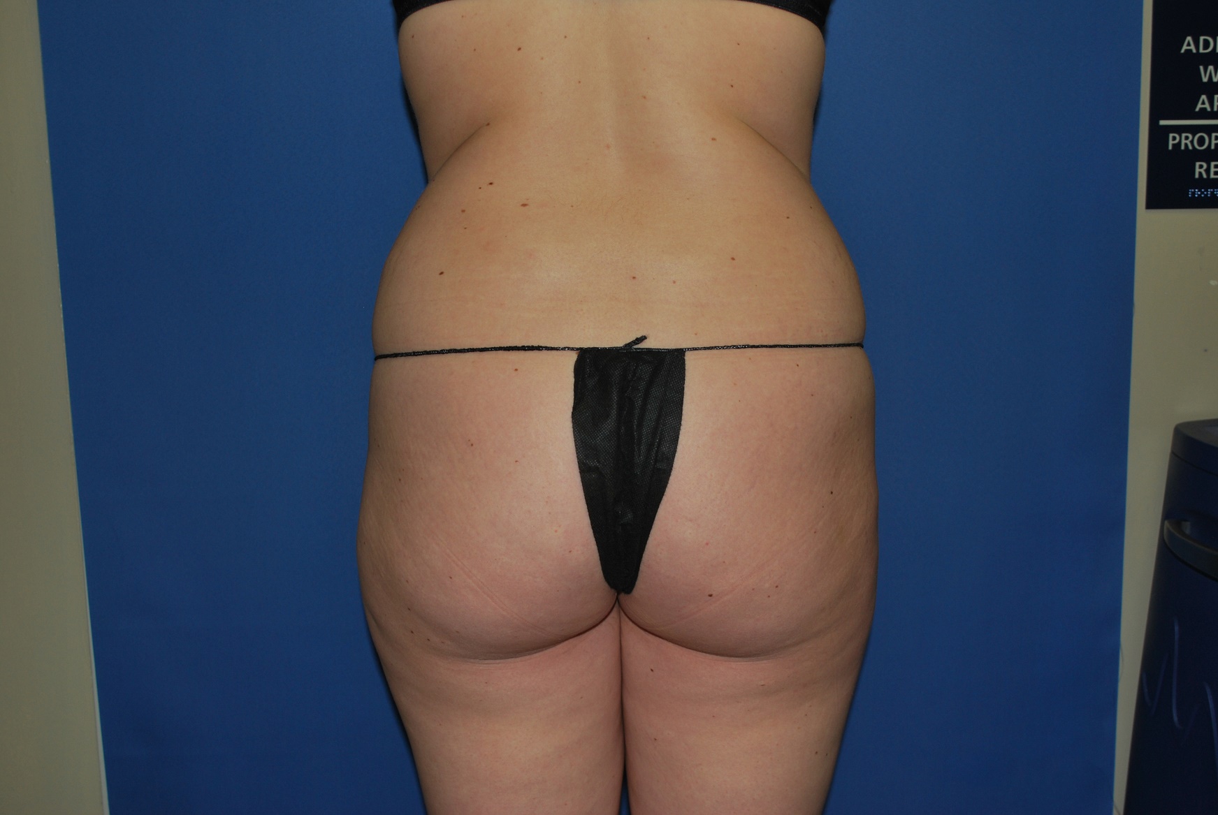 Booty Boost Patient Photo - Case 4675 - before view-