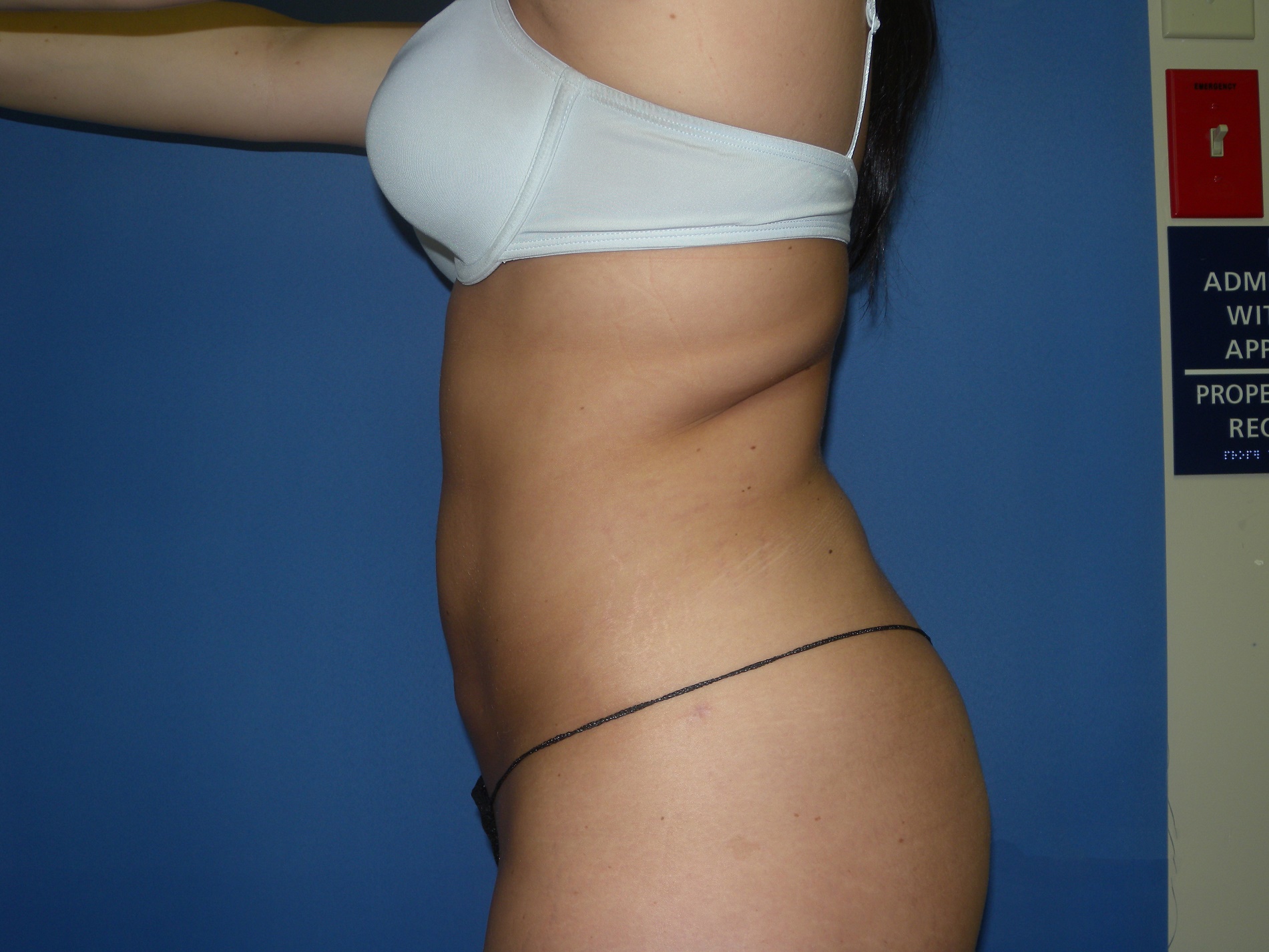 Booty Boost Patient Photo - Case 4675 - after view-2