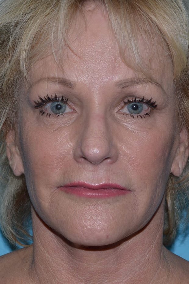 Eyelid Surgery Patient Photo - Case 5093 - before view-0