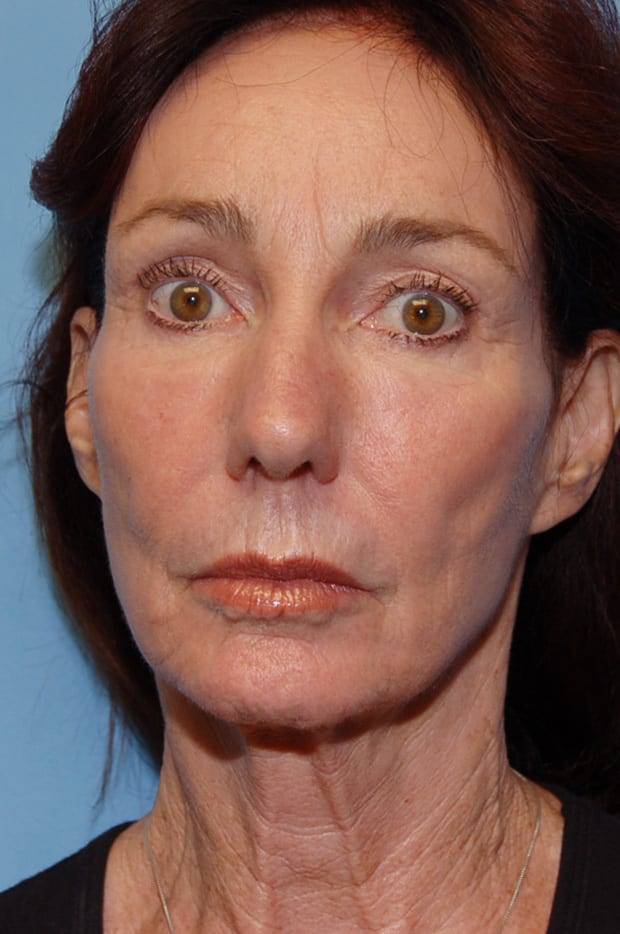 Microlift Patient Photo - Case 5098 - before view-0