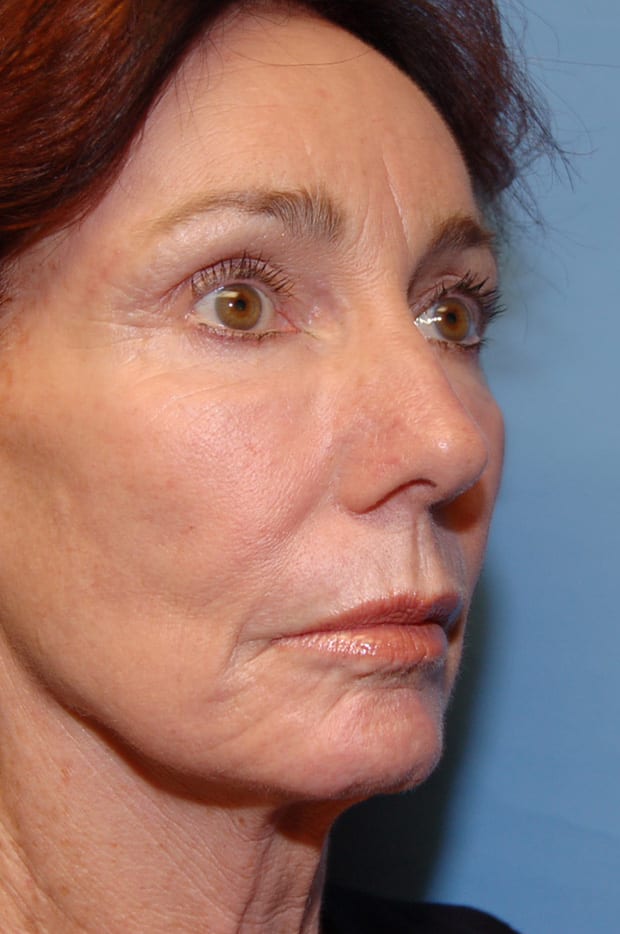 Microlift Patient Photo - Case 5098 - before view-1