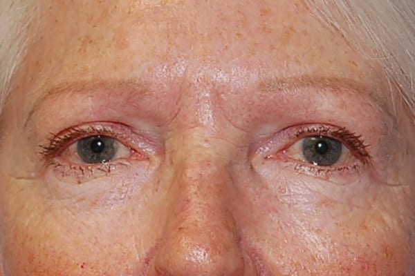 Upper Eyelid Lift Patient Photo - Case 5112 - after view-0