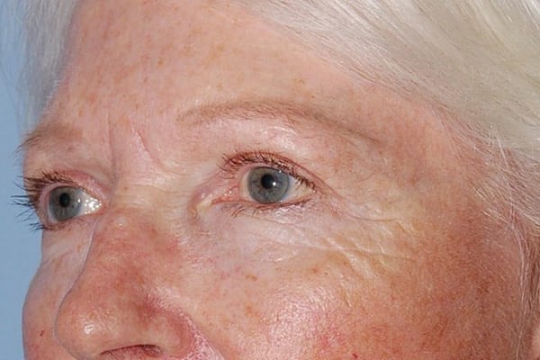 Upper Eyelid Lift Patient Photo - Case 5112 - after view-1