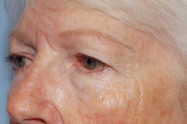 Upper Eyelid Lift Patient Photo - Case 5112 - before view-1