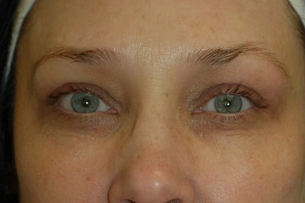 Upper Eyelid Lift - Case 5119 - After