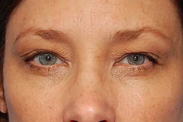 Upper Eyelid Lift Patient Photo - Case 5119 - before view-