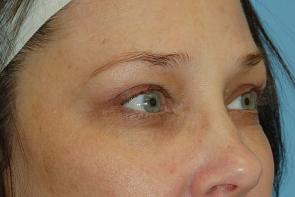 Upper Eyelid Lift Patient Photo - Case 5119 - after view-1