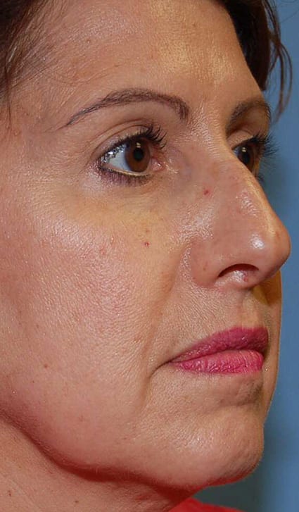 Facial Rejuvenation Patient Photo - Case 5136 - before view-1