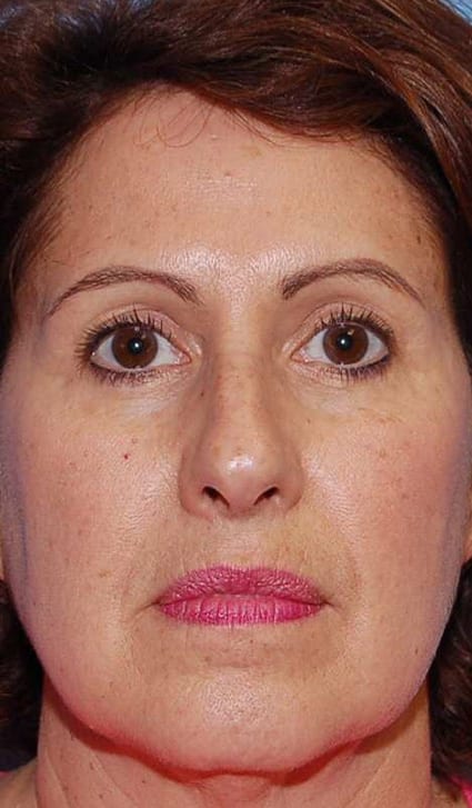 Facial Rejuvenation - Case 5136 - Before