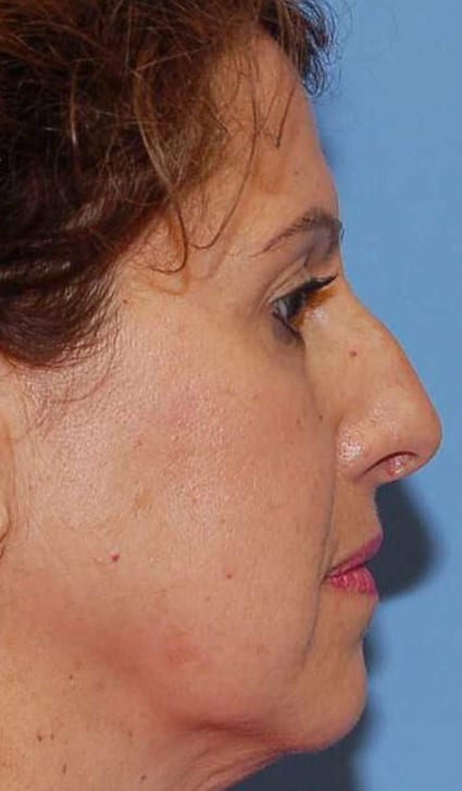 Facial Rejuvenation Patient Photo - Case 5136 - before view-2