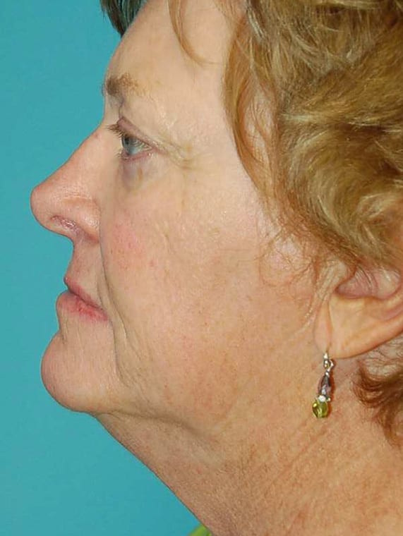 Facial Rejuvenation Patient Photo - Case 5145 - before view-1