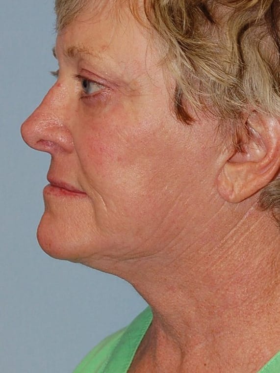 Facial Rejuvenation Patient Photo - Case 5145 - after view-1