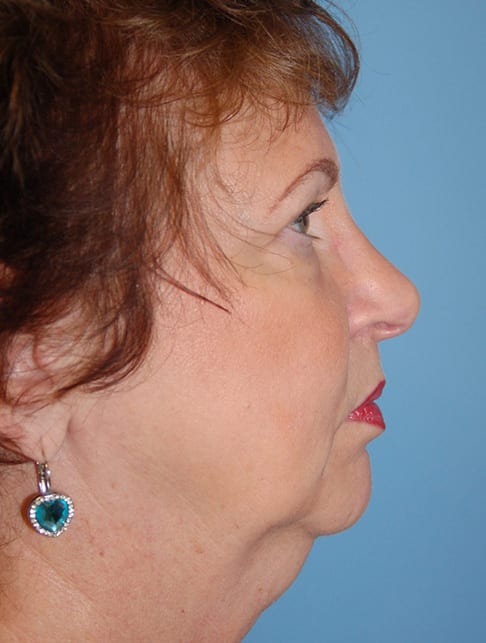 Facial Rejuvenation Patient Photo - Case 5172 - before view-3