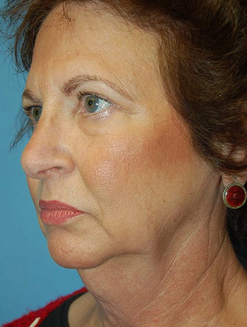 Facial Rejuvenation Patient Photo - Case 5172 - before view-1