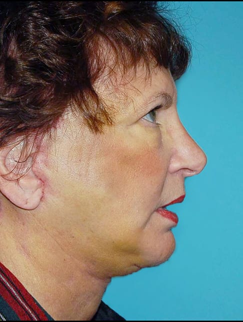Facial Rejuvenation Patient Photo - Case 5172 - after view-3