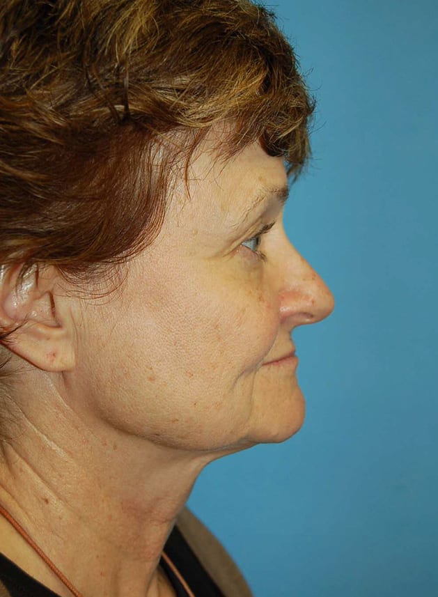 Facial Rejuvenation Patient Photo - Case 5186 - before view-2