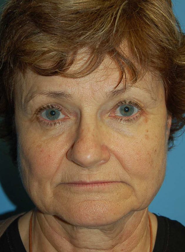 Facial Rejuvenation Patient Photo - Case 5186 - before view-0