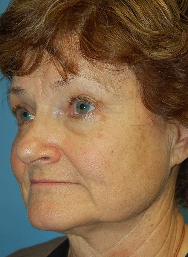 Facial Rejuvenation Patient Photo - Case 5186 - before view-3