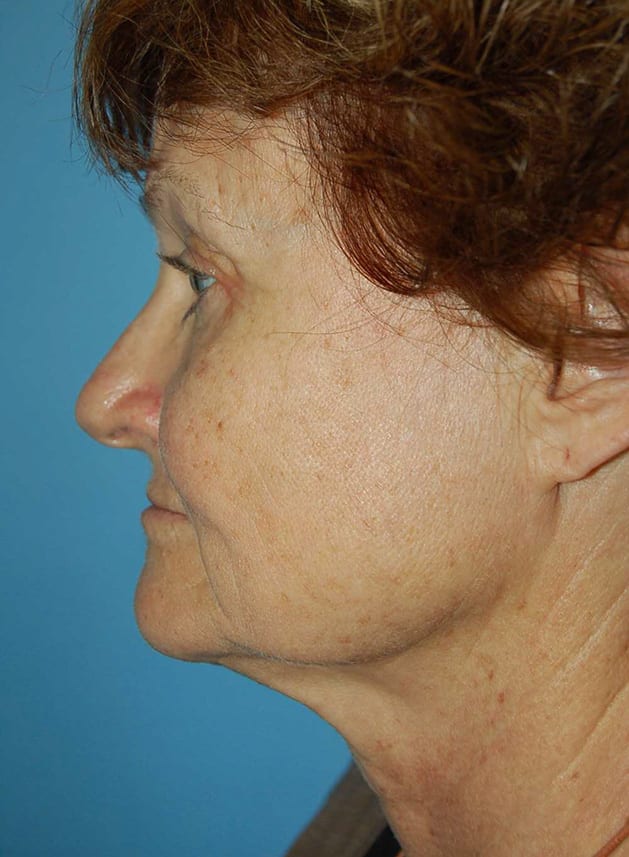 Facial Rejuvenation Patient Photo - Case 5186 - before view-2