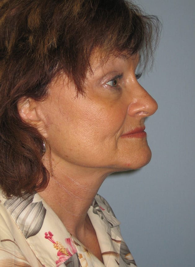 Facial Rejuvenation Patient Photo - Case 5186 - after view-2