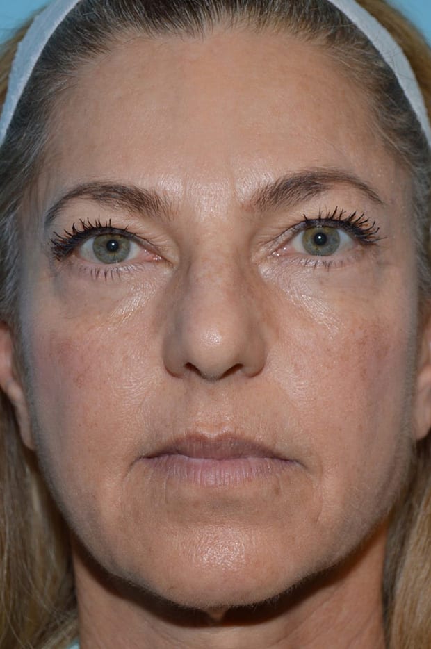 Forehead Lift Patient Photo - Case 5205 - before view-