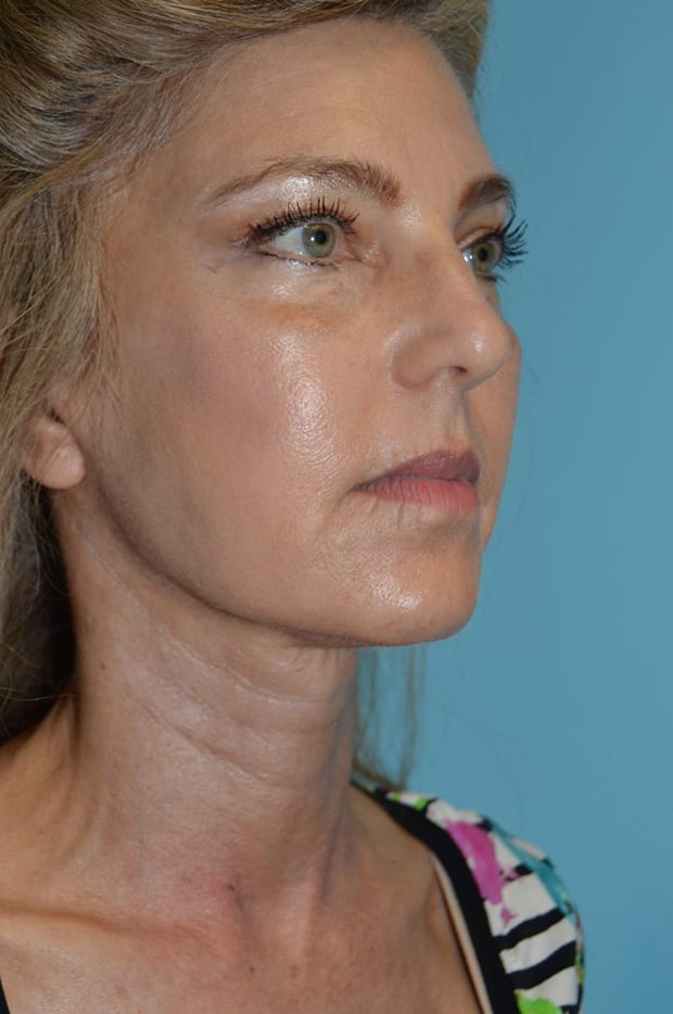 Forehead Lift Patient Photo - Case 5205 - after view-3