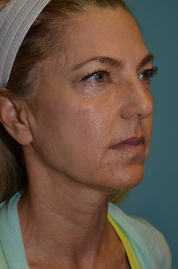 Forehead Lift Patient Photo - Case 5205 - before view-3