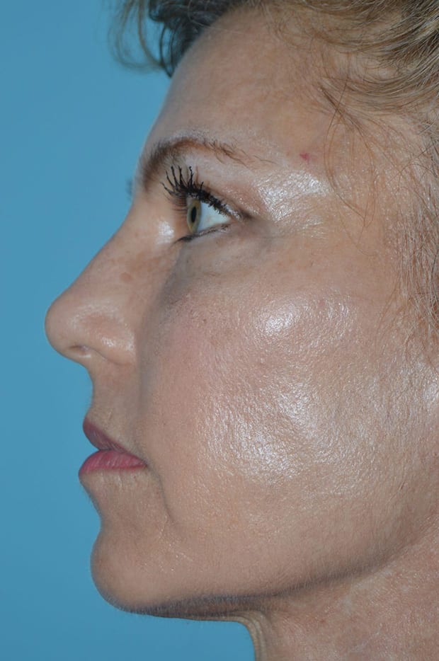 Forehead Lift Patient Photo - Case 5205 - after view-2