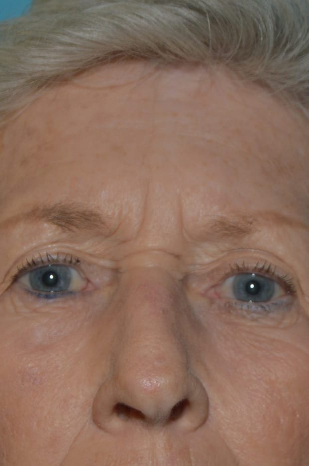 Forehead Lift - Case 5216 - Before